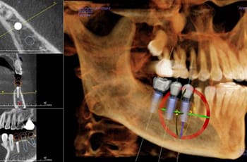 dental implant xray of scull