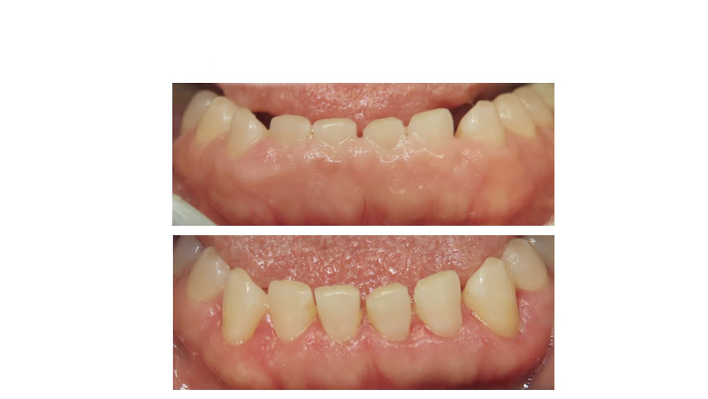 before and after of a patient's gummy smile